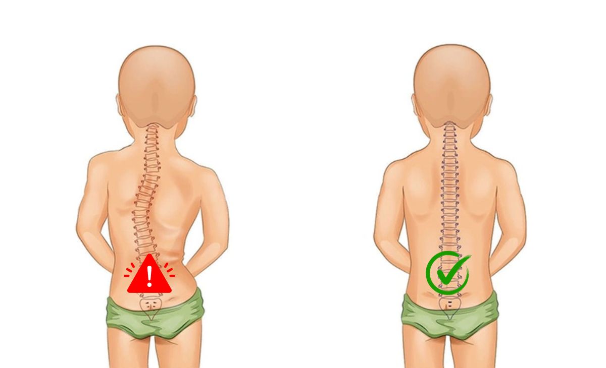 Những bệnh nguy hiểm nếu như con em bạn gặp vấn đề về cột sống Những bệnh nguy hiểm nếu như con em bạn gặp vấn đề về cột sống