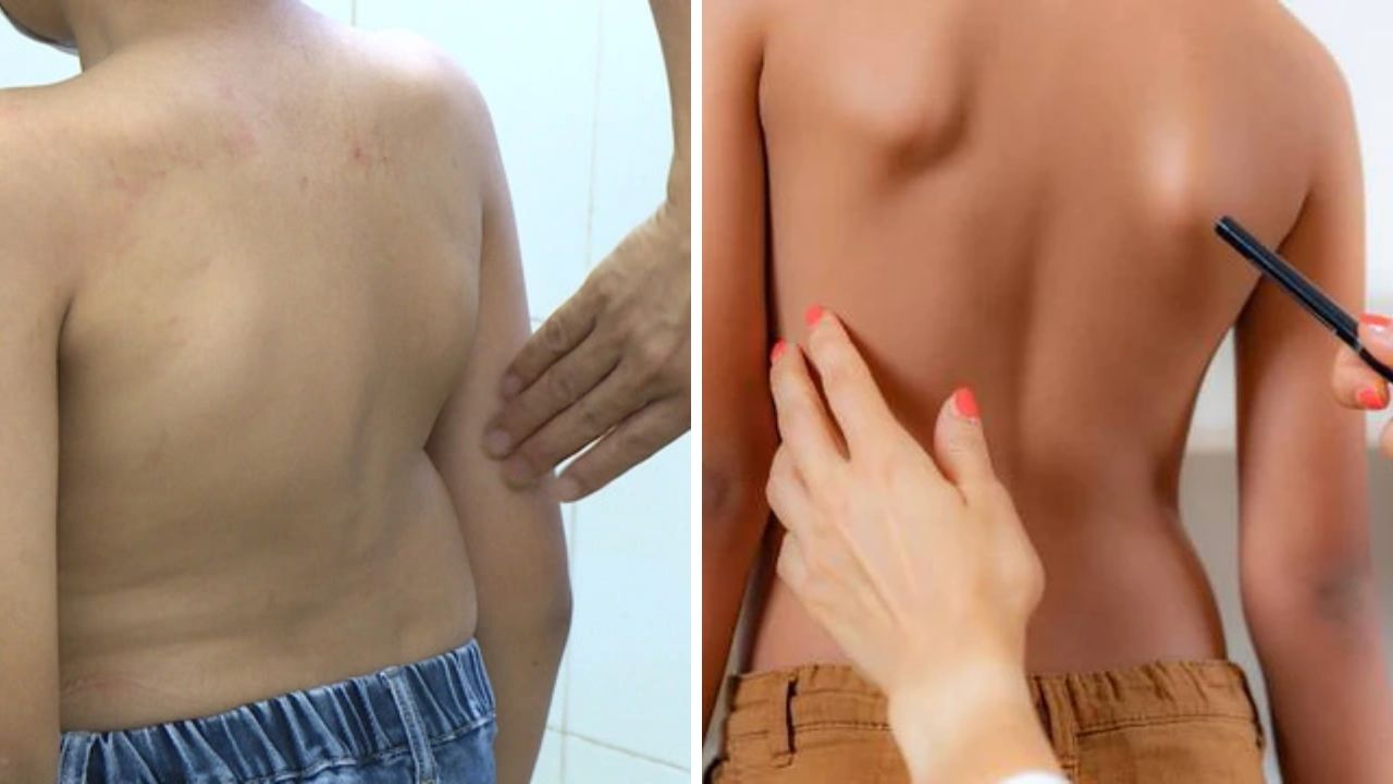 Hậu quả của gù lưng Hậu quả của gù lưng