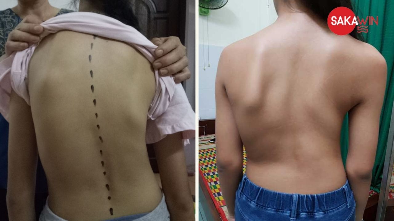 Đặc điểm của gù lưng ở trẻ nhỏ Đặc điểm của gù lưng ở trẻ nhỏ