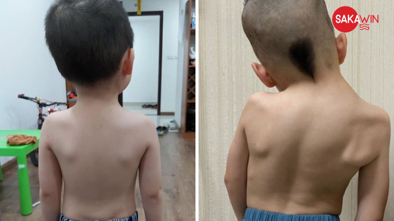Vẹo cột sống (Scoliosis)